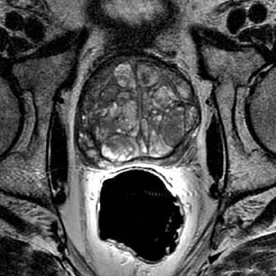 Prostate MRI