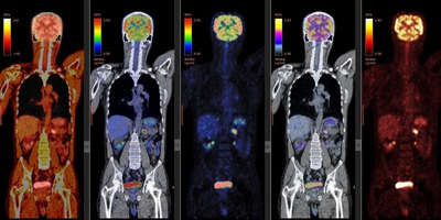 PET CT imaging