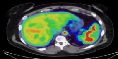 PET imaging of liver inflammation