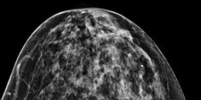 UC Davis Health's new ultra-high-resolution CT scanner