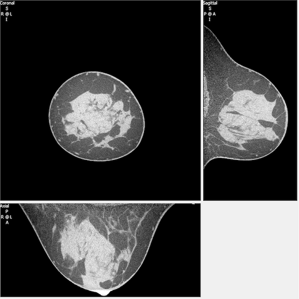 Figure 2: The reconstructed full data set from breast CT results in a high-resolution (150 µm voxels) depiction of the breast in three dimensions. Here, the coronal (upper left), sagittal (upper right), and axial (bottom) images of a breast are shown.