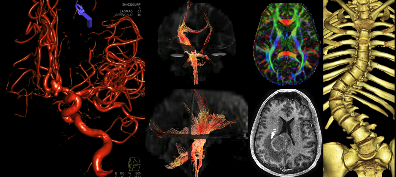 Neuroradiology Department Of Radiology Uc Davis Health