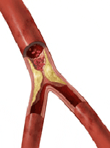 artery blockage