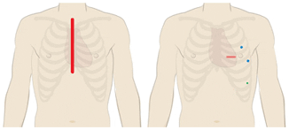 Open surgery incision vs. robotics-assisted surgery incision points