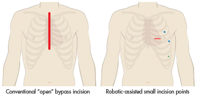 open surgery incision vs. robotic assisted surgery incision points