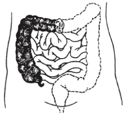 Ascending colostomy image