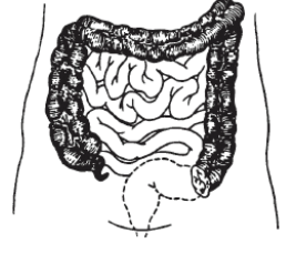 Sigmoid colostomy image