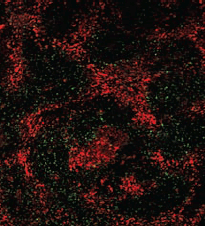 Photo — Progressively magnified fluorescent microscopy images show red and green glioma cells growing in and around black areas of dead tumor tissue. Experimental drugs under development at UC Davis are designed to kill and prevent the recurrence of these cancer cells even within tumor regions with poor blood supply.