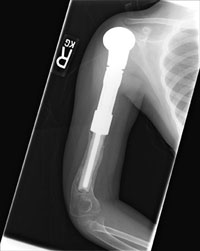 PHOTO — X-ray of Francesca's right arm, showing her metal prosthesis.