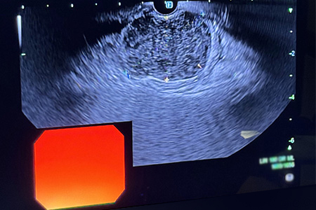 Endoscopic ultrasound image of needle  used to obtain the core tissue biopsy