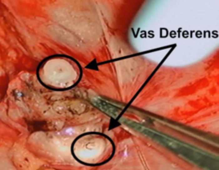 Vasectomy Reversal procedure_2