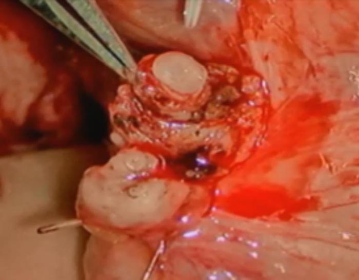 Vasectomy Reversal procedure_3