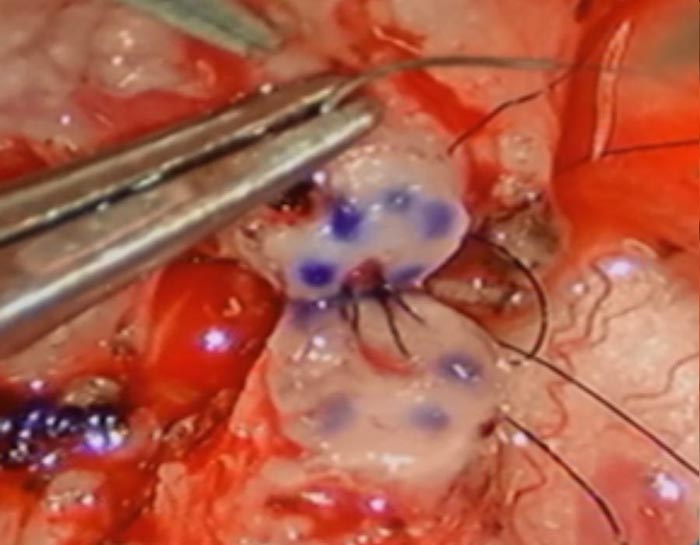 Vasectomy Reversal procedure_6