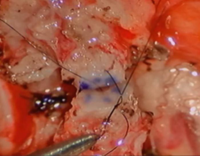 Vasectomy Reversal procedure_7