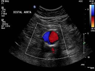Duplex ultrasound of a 5.5 centimeter abdominal aortic aneurysm