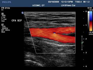 Arterial duplex scan image